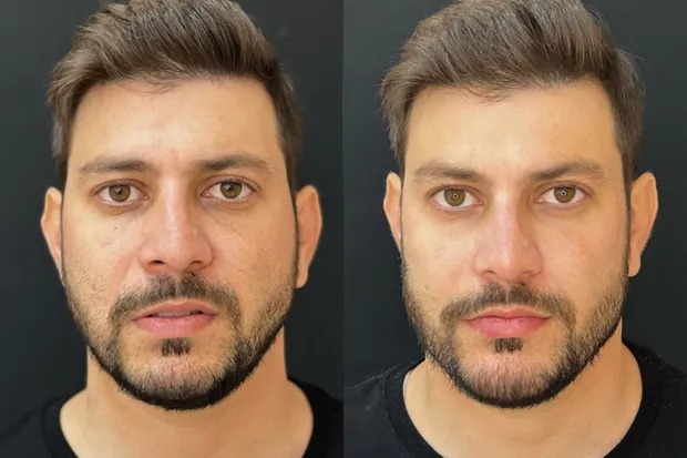 Ex Bbb Caio Afiune Faz Harmoniza O Facial Veja Antes E Depois Hugo Gloss