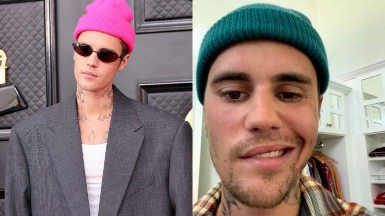 Justin Bieber Sindrome Rosto Paralisado