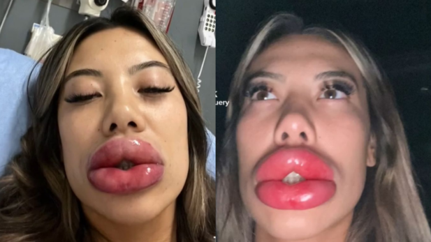 Menina viraliza com reação alérgica após preenchimento labial (Foto: Reprodução/TikTok)