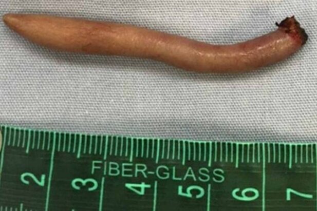 A "cauda" tinha quase 6 cm de comprimento (Foto: Divulgação/Journal of Pediatric Surgery)