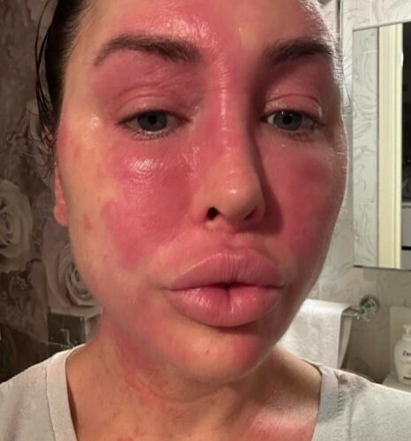 Laura ficou com o rosto inchado depois de ter uma reação alérgica (Foto: Reprodução/Instagram)