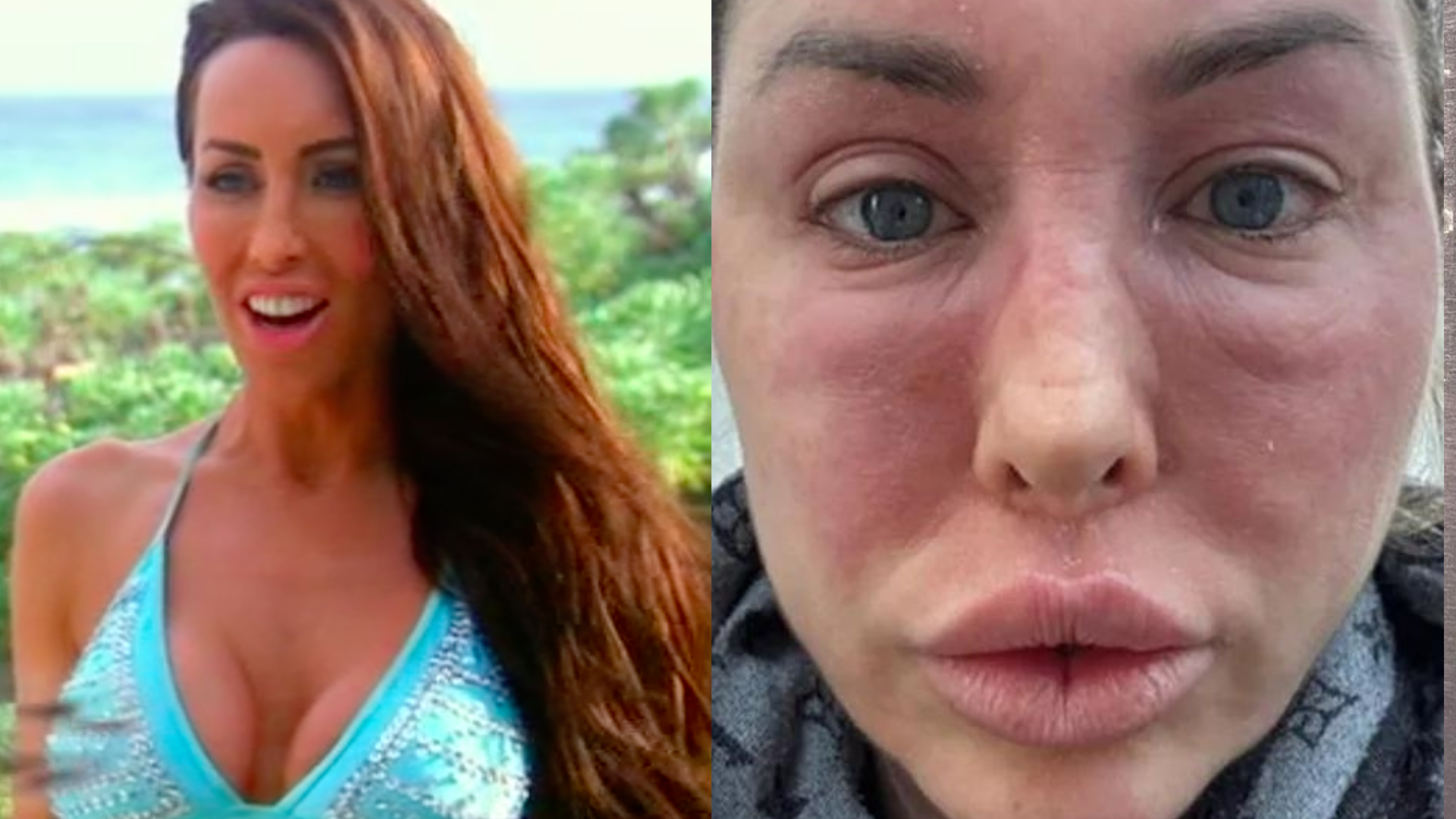 Estrela de reality britânico fica com o rosto desfigurado após reação alérgica