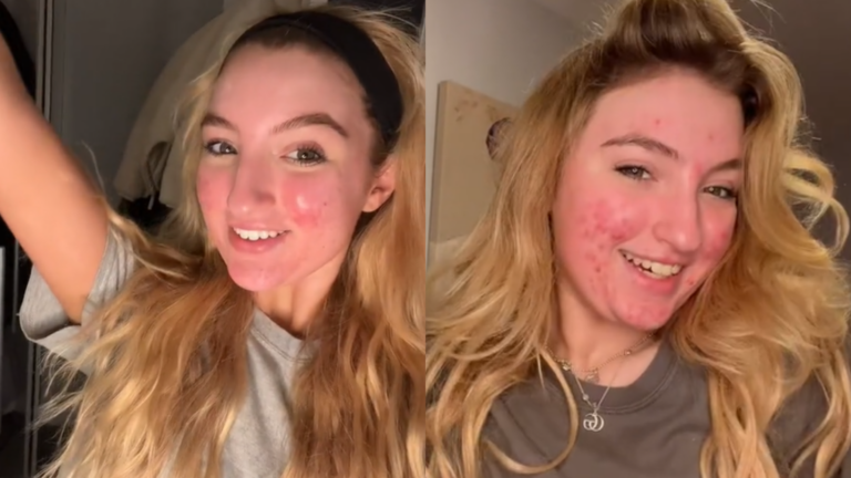 Tiktok Acne