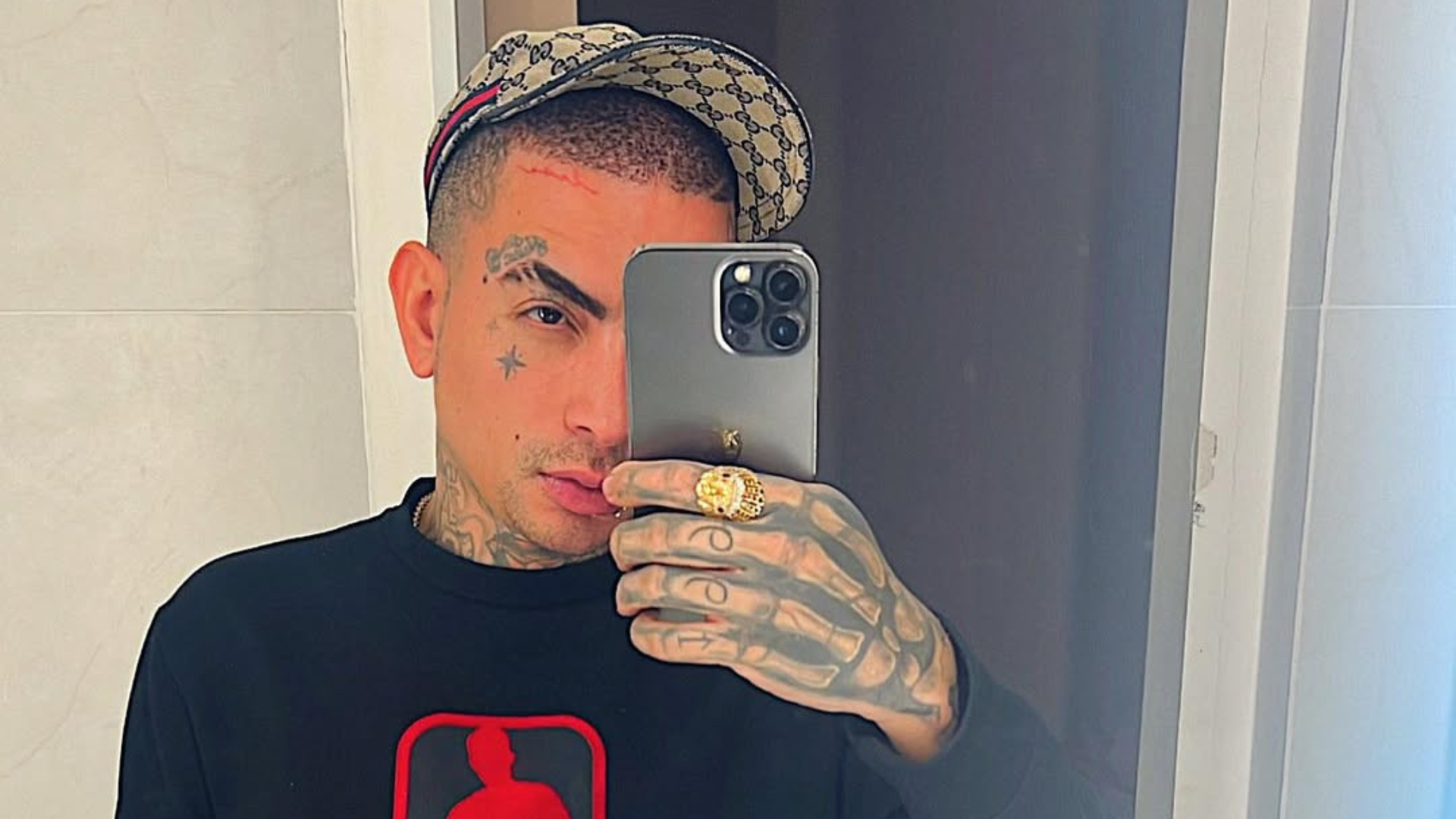 MC Guimê faz harmonização facial e mostra resultado; veja antes e depois