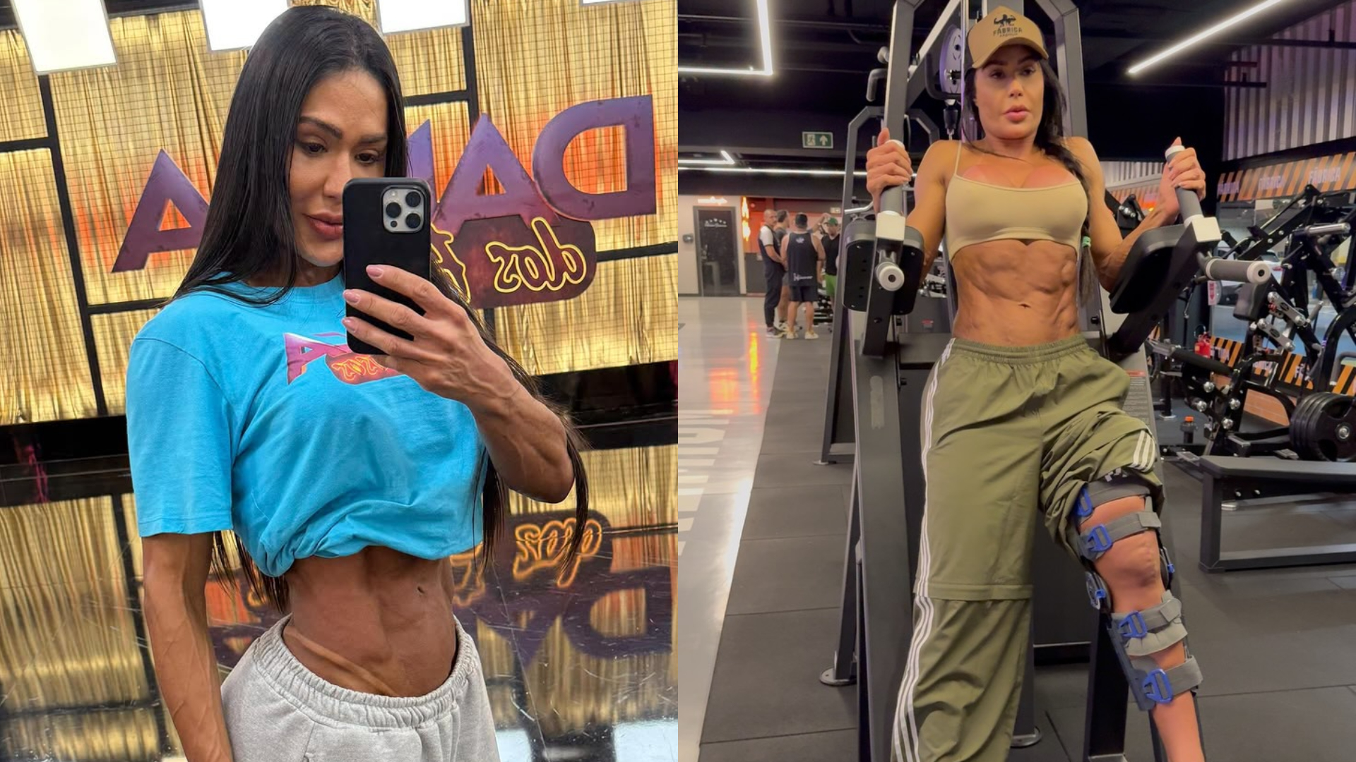 Gracyanne Barbosa mostra cicatriz e atualiza recuperação após cirurgia no joelho Gracyanne Barbosa mostra cicatriz e atualiza recuperação após cirurgia no joelho