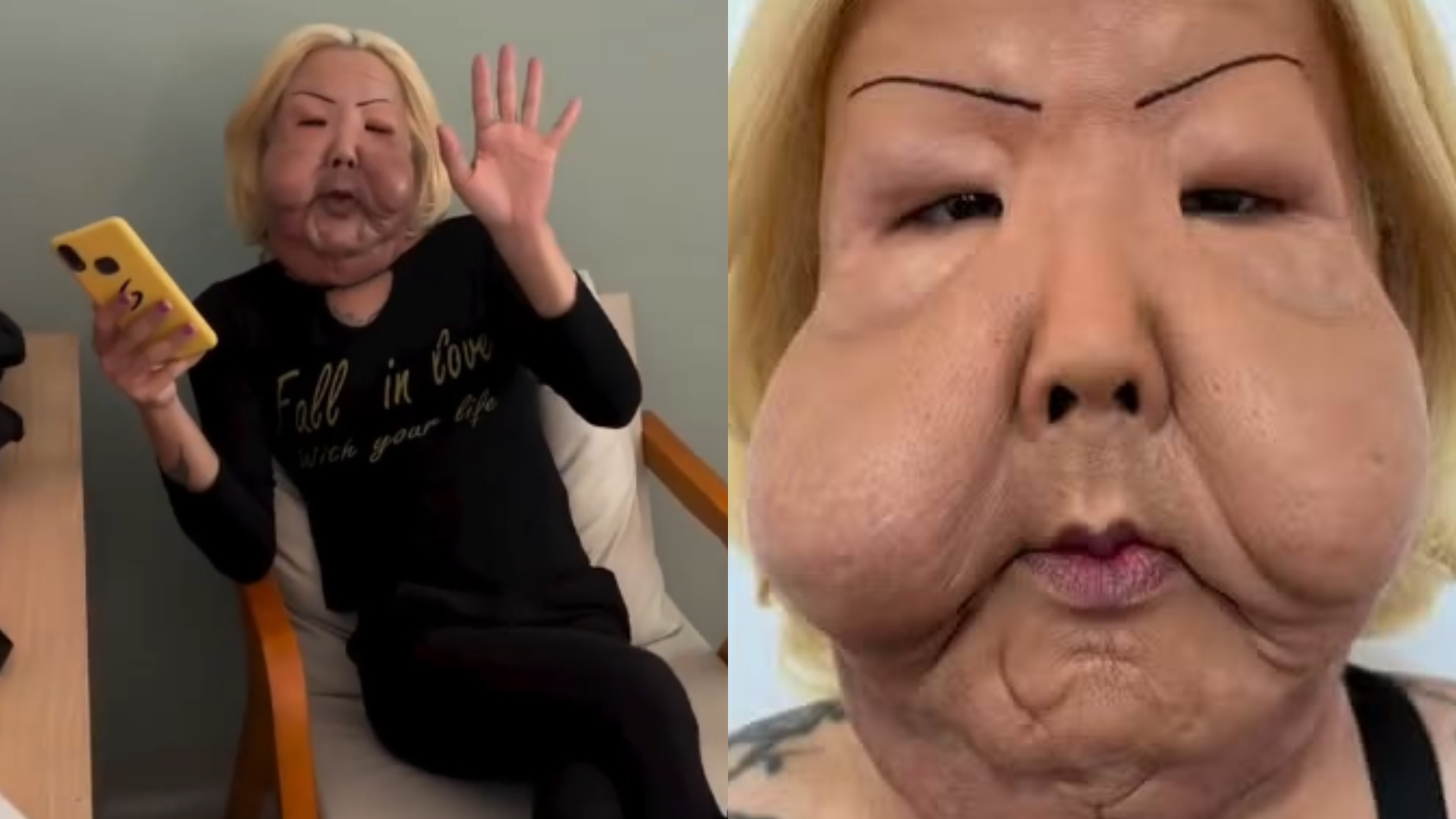 Médico surpreende ao mostrar óleo mineral enrijecido retirado do rosto de Juju do Pix: “Foi muito difícil”; veja foto Médico surpreende ao mostrar óleo mineral enrijecido retirado do rosto de Juju do Pix: “Foi muito difícil”; veja foto