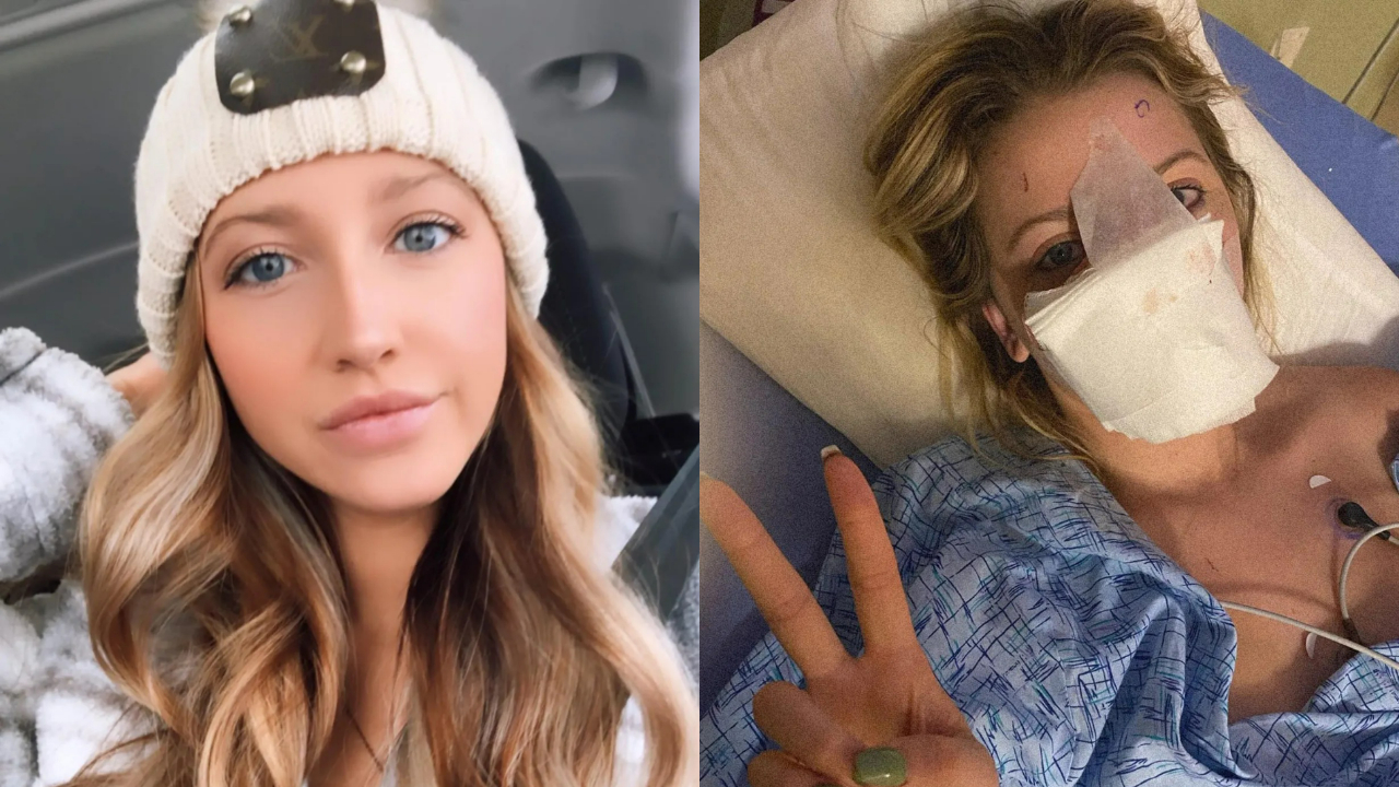 Jovem que teve o nariz arrancado por cachorro reaparece após 16 cirurgias, mostra antes e depois, e revela destino do animal; assista Jovem que teve o nariz arrancado por cachorro reaparece após 16 cirurgias, mostra antes e depois, e revela destino do animal; assista