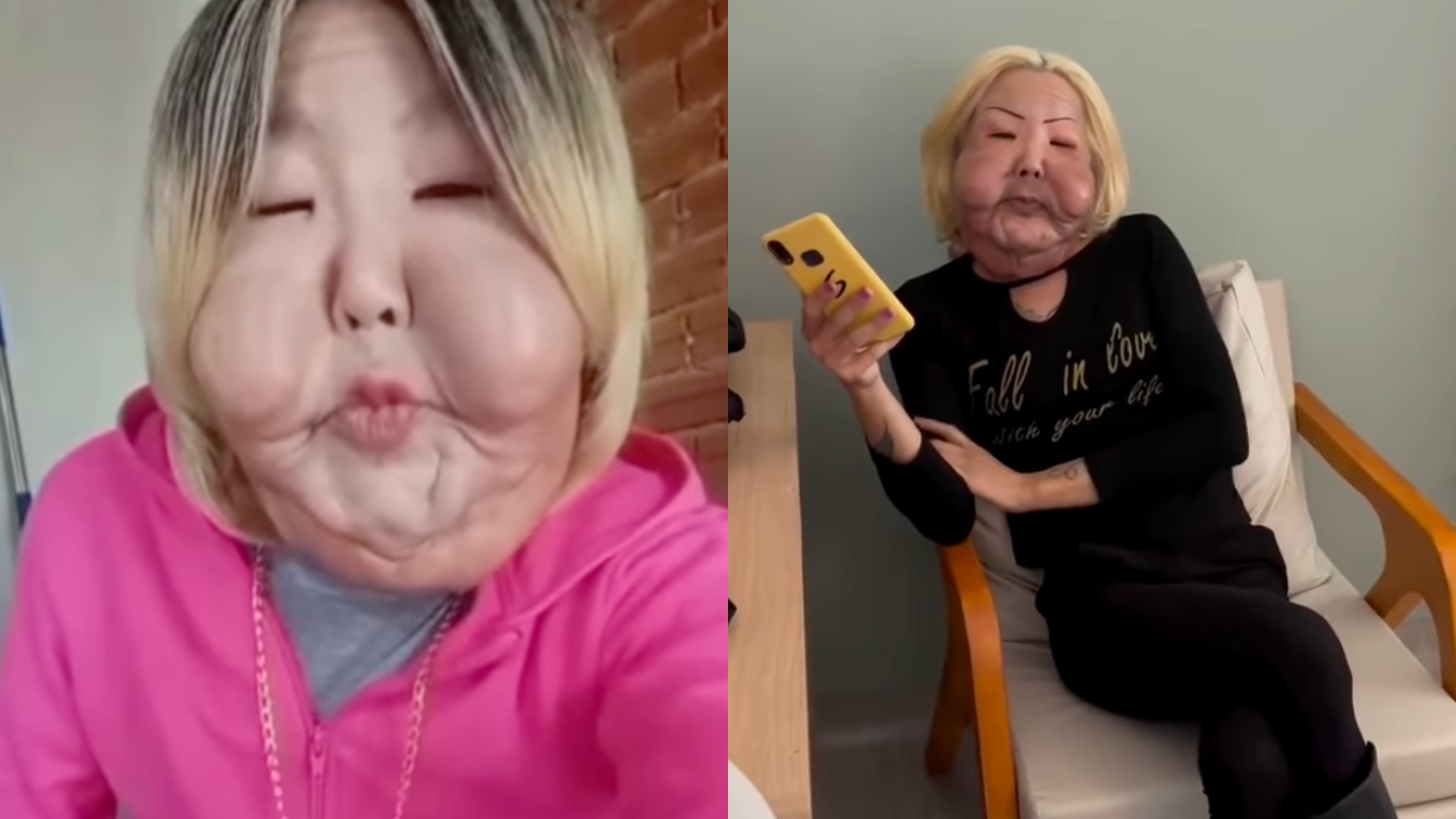 Vídeo: Influenciadora Juju do Pix passa por cirurgia para reconstruir o rosto e exibe antes e depois Vídeo: Influenciadora Juju do Pix passa por cirurgia para reconstruir o rosto e exibe antes e depois