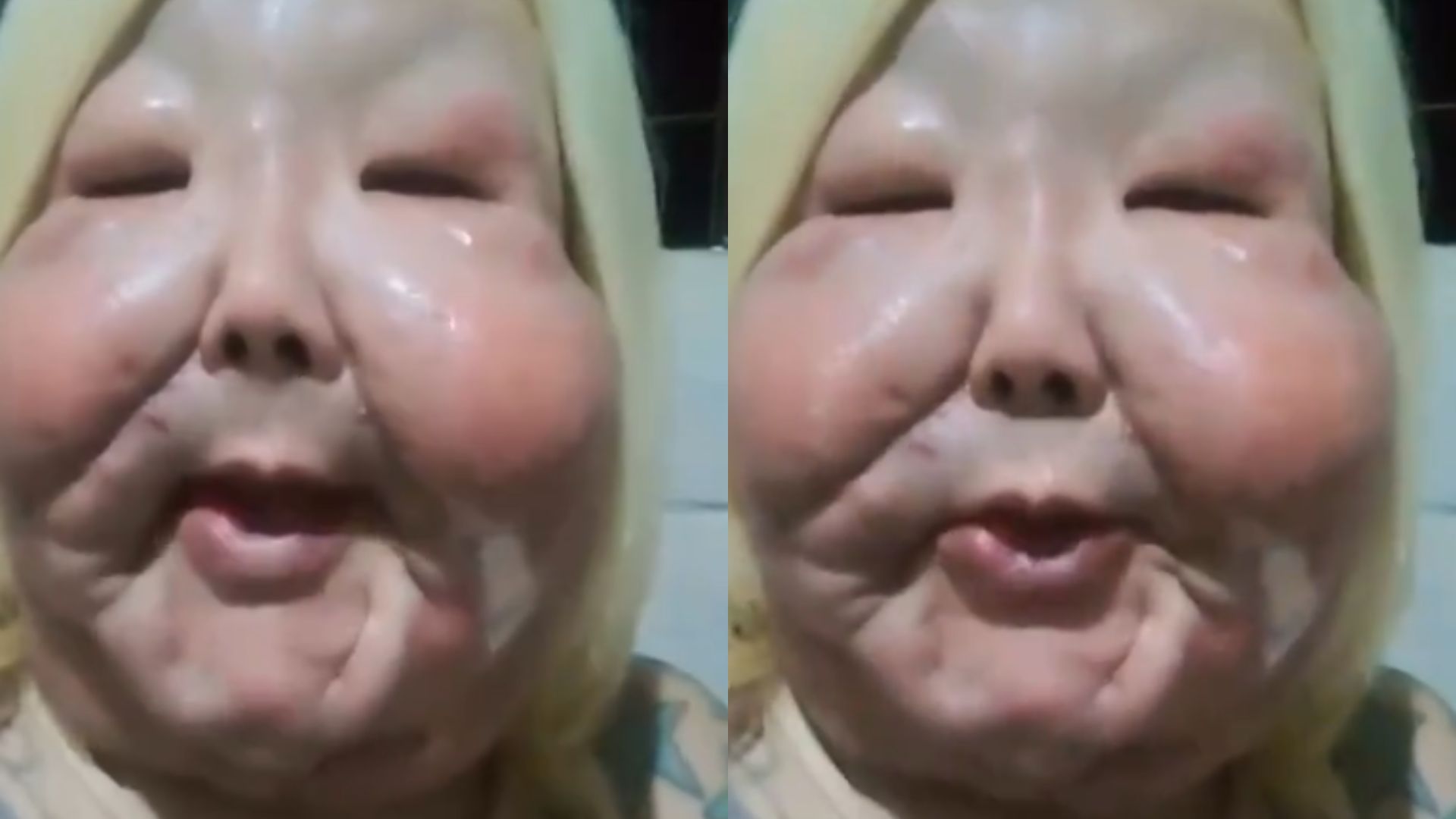 Juju do Pix relata complicação após cirurgia para retirada de óleo industrial do rosto; assista